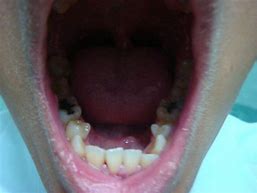 Image result for Deep Clean Teeth