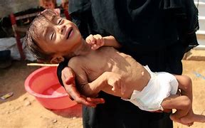 Image result for Yemen Famine