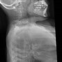 Image result for Morquio Syndrome
