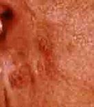 Image result for Dark Spots On Skin Cancer