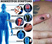 Image result for Monkeypox Signs