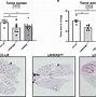 Image result for Stage 2 Lung Cancer Papers