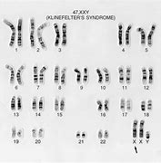 Image result for 47 XXY Klinefelter Syndrome