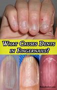 Image result for Dents in Fingernails