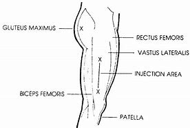 Image result for IM Injection Sites Chart