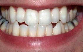 Image result for Small Teeth
