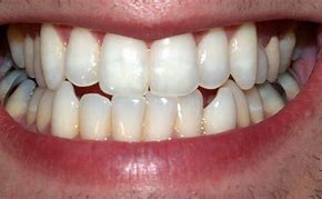 Image result for Crooked Teeth Before and After