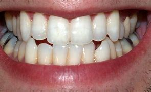 Image result for Teeth Cleaning Products