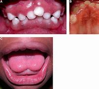 Image result for Robinow Syndrome