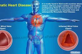 Image result for Rheumatic Heart Disease