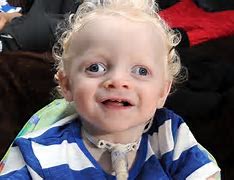 Image result for Children with Angelman Syndrome