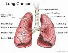 Image result for Lung Cancer Stage 4 Progression