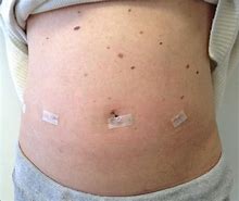 Image result for Hernia Surgery Scar