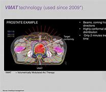Image result for Volumetric Modulated Arc Therapy