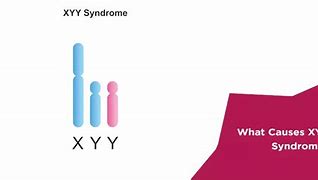 Image result for XYY Syndrome Symptoms