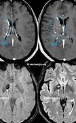 Image result for Right Frontal Lobe Developmental Venous Anomaly