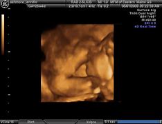 Image result for 26 Weeks Ultrasound Twins