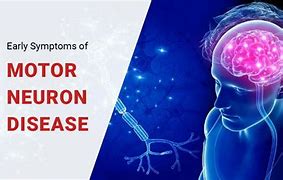 Image result for Motor Neurone Disease