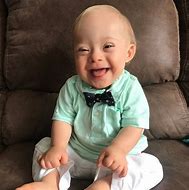 Image result for Syndrome Babies Down