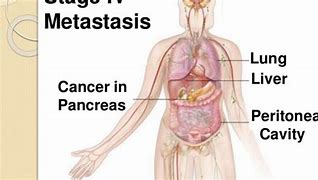 Image result for Stage 4 Pancreatic Cancer