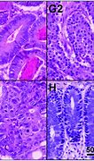Image result for Stage 4 Intestinal Cancer