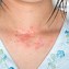 Image result for Common Skin Rashes