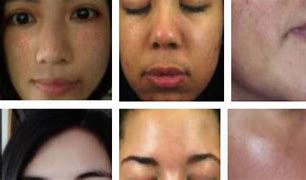 Image result for Skin Bleaching Cream Before and After