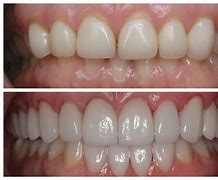 Image result for Porcelain Veneers Before and After