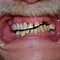 Image result for Partial Dentures