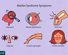 Image result for Marfan Disorder