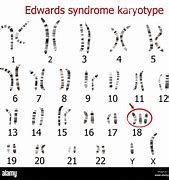 Image result for Edwards Syndrome Diagram