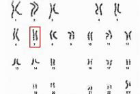 Image result for Williams Syndrome Karyotype