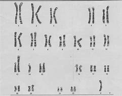 Image result for Turner Syndrome Karyotype