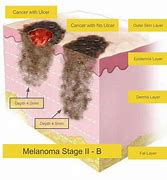 Image result for Level 4 Melanoma