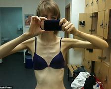 Image result for Anorexia Chloe