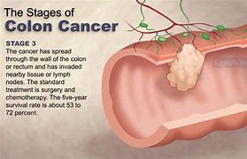 Image result for Stage 4 Intestinal Cancer