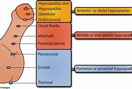 Image result for Grades of Hypospadias
