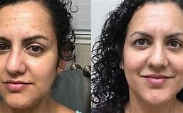 Image result for Skin Lightening Cream Meladerm Before and After