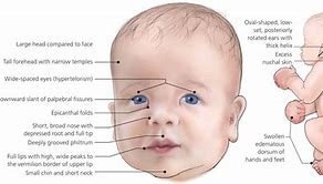 Image result for Noonan Syndrome Facial Features