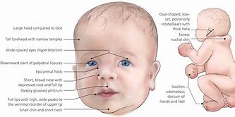 Image result for Noonan Syndrome Causes