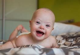 Image result for A Child with Down Syndrome