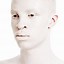 Image result for Albino Boy with White Hair