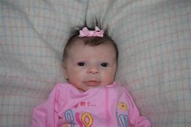 Image result for Williams Syndrome Baby