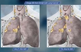 Image result for Is Lung Cancer Treatable