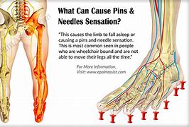 Image result for Pins and Needles in Legs