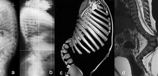 Image result for Hurler Syndrome Spine