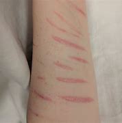 Image result for Scars From Blemishes