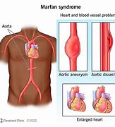 Image result for How Common Is Marfan Syndrome