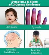 Image result for What Is DiGeorge Syndrome