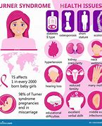 Image result for Effects of Turner Syndrome